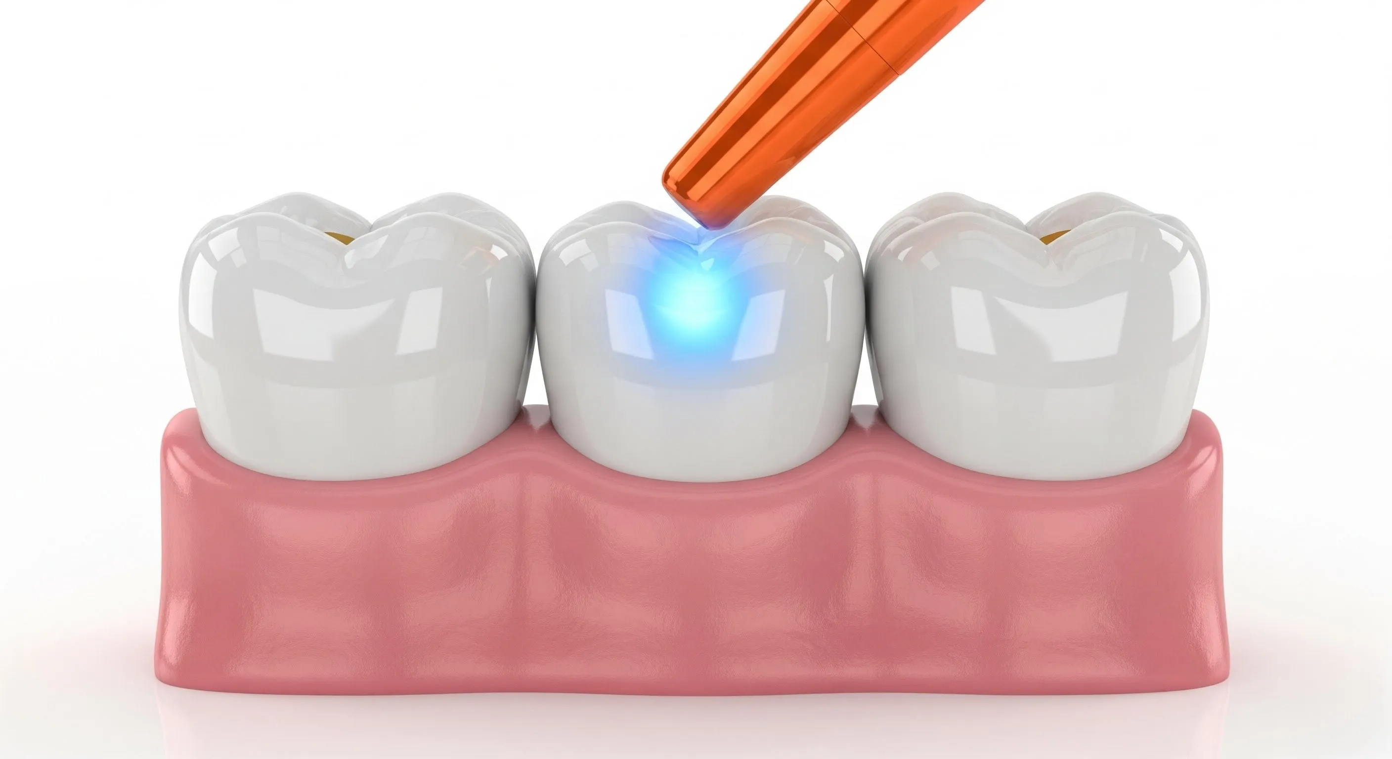 Composite Fillings Cost and Pricing Information in Alexandria
