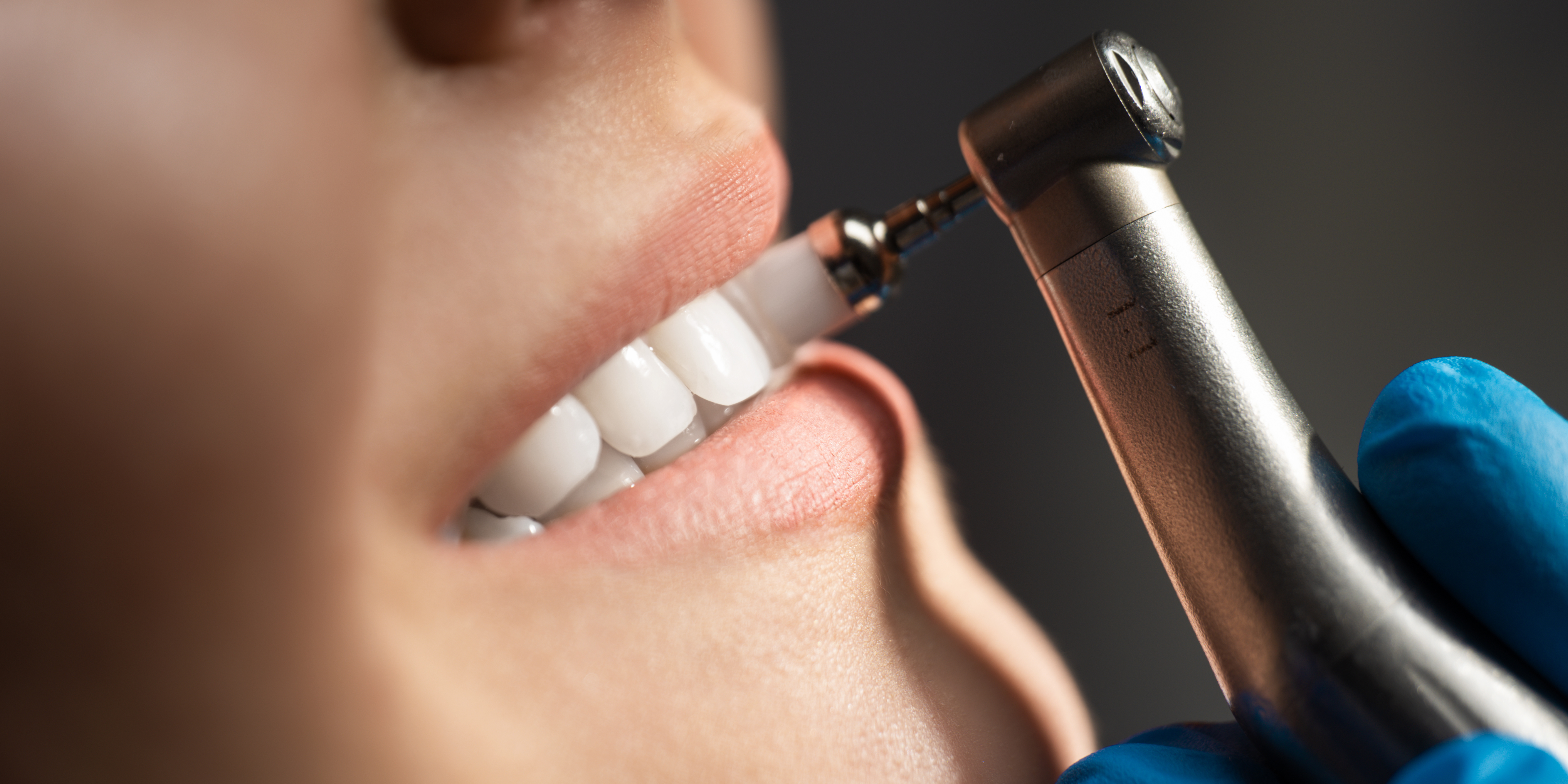 Todays Dental Alexandria - Dental Sealants
