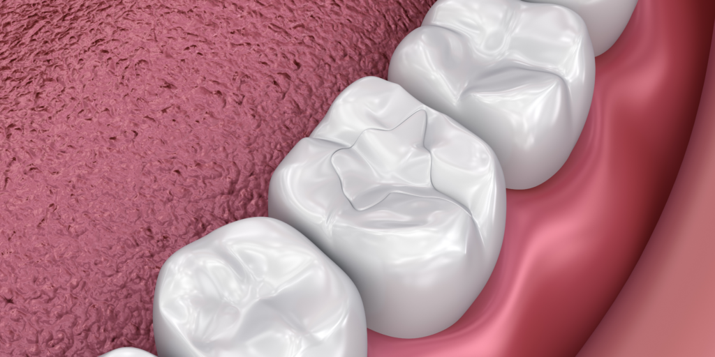 Composite Fillings - Todays Dental Alexandria