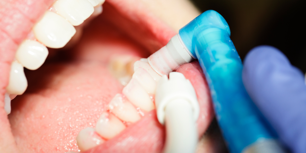 Dental Bonding - Todays Dental Alexandria