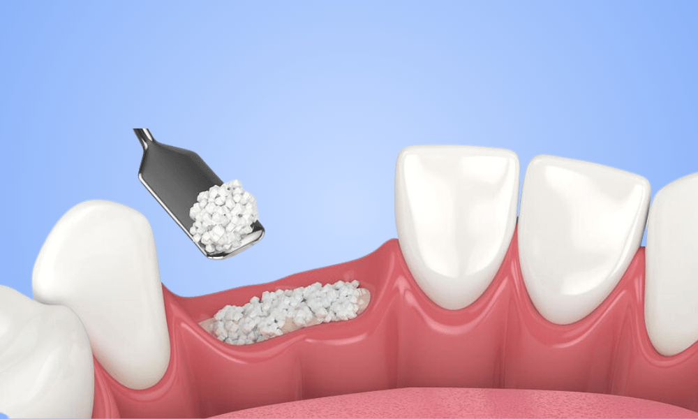 Why Choose Bone Grafting in Alexandria?