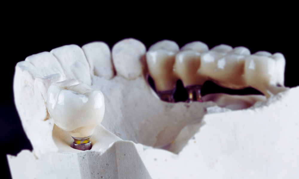 Types of Dental Bridges