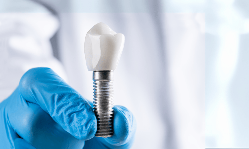 Why Choose Todays dental Alexandria for Dental Implants?