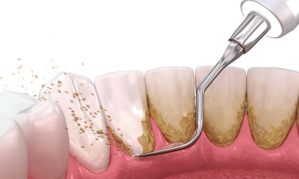 Periodontic Treatments