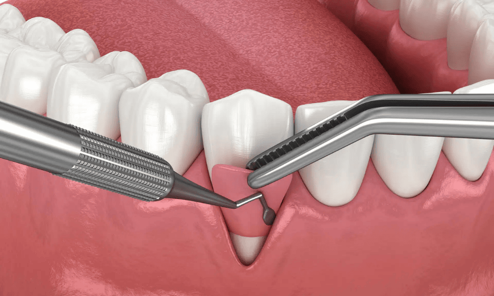 Types of Periodontic Treatments