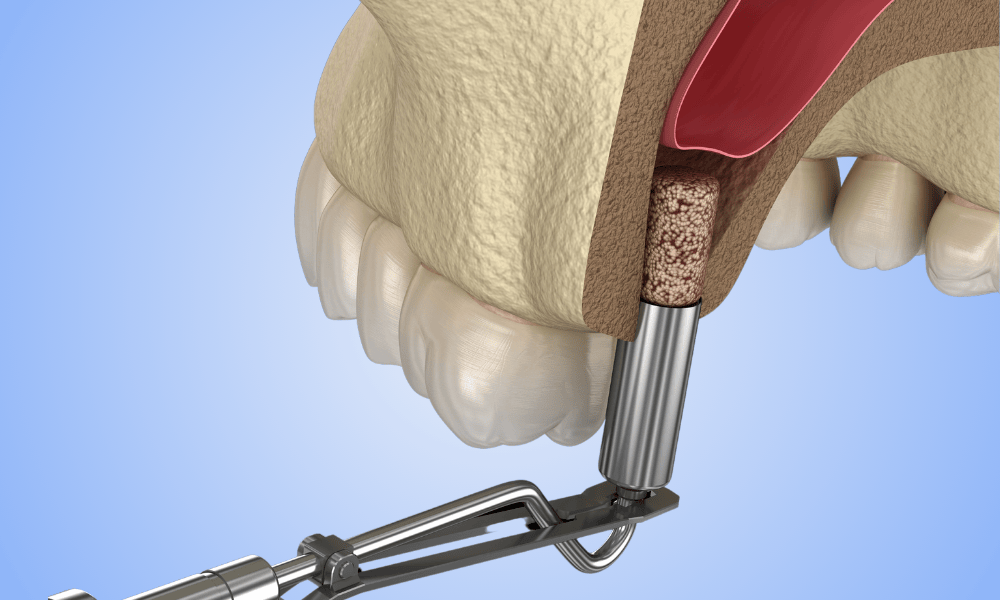 Types of Bone Grafting Procedures