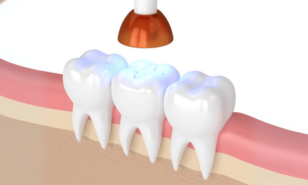 Composite Fillings Cost and Pricing Information in Alexandria